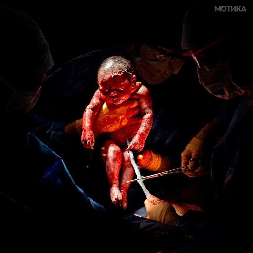 newborn-infant-photos-c-section-cesar-christian-berthelot-1